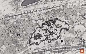 M, 7w. | mitochondrial cardiomyopathy (N - nucleus, M - megamitochondria,R - dilated endoplasmic reticulum)- autopsy sample M, 7w. | mitochondrial cardiomyopathy (N - nucleus, M - megamitochondria,R - dilated endoplasmic reticulum)- autopsy sample